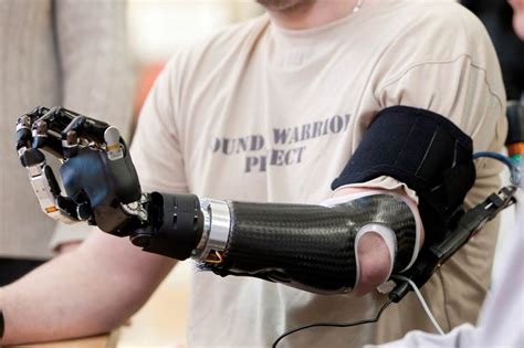 Bionic Arm Gives Amputees A Hand