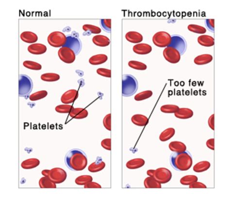 Low Platelet Count My Blood Stopped Clotting
