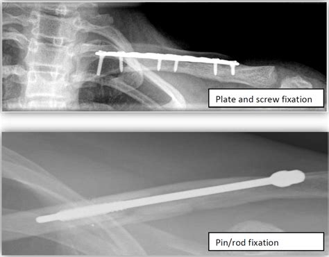 Clavicle Collar Bone Fractures Boston Shoulder Institute