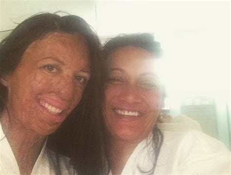 Turia Pitt S New Nose Surgery Wasn T Without Complications