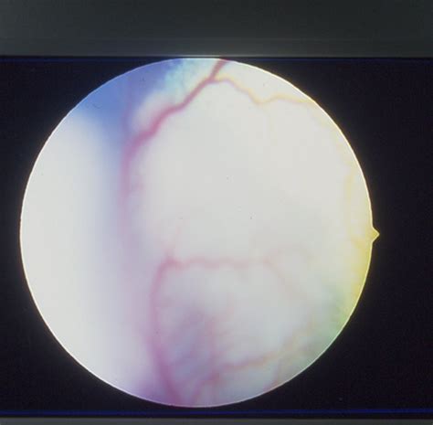 Retinal detachment is a sight threatening condition with an incidence of approximately 1 in 10000. Retina: detachment in cats | Vetlexicon Felis from ...