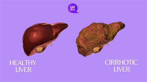Liver Cirrhosis Understanding The Symptoms And Treatment