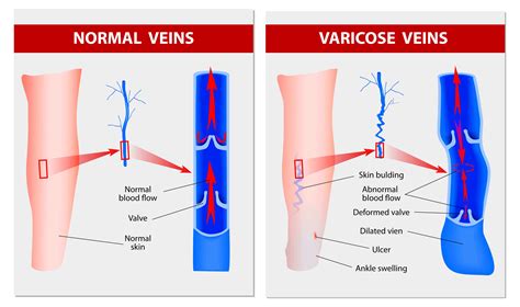 Laser Treatment For Varicose Veins And Spider Veins