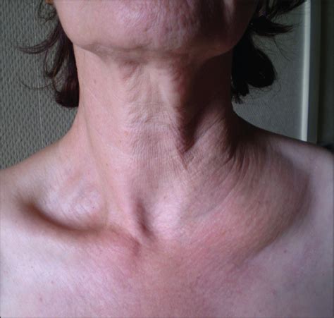 Collection 98 Pictures Pictures Of Swollen Collar Bone Updated