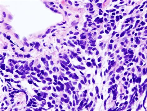 Small Cell Carcinoma Of The Lung Pathophysiology Wikidoc