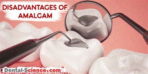A mechanical device called an amalgamator or triturator. Amalgam filling: is it the best choice for you? - Dental ...