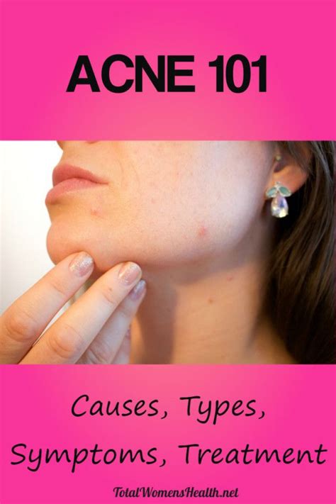 Acne 101 Causes Types Symptoms Treatments Acne Treatment Best