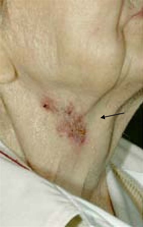 Recurrent Neck Abscesses Due To Cervical Tuberculous Lymphadenopathy In