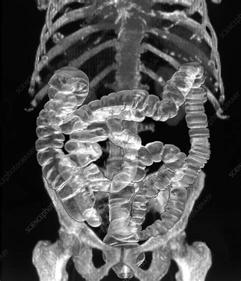 Normal Intestines 3d Ct Scan Stock Image P5600187 Science Photo