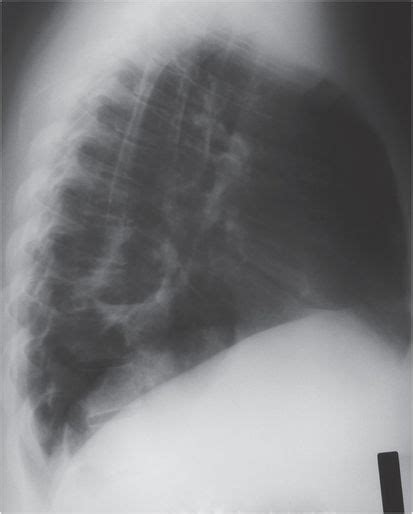 Pulmonary Coccidioidomycosis