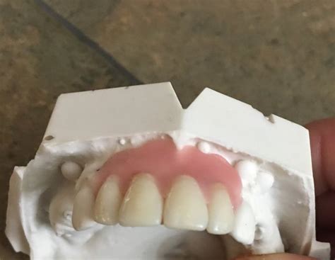How to care for a chipped or broken tooth. Missing Tooth Kit Front Flipper Denture Resin Denture ...