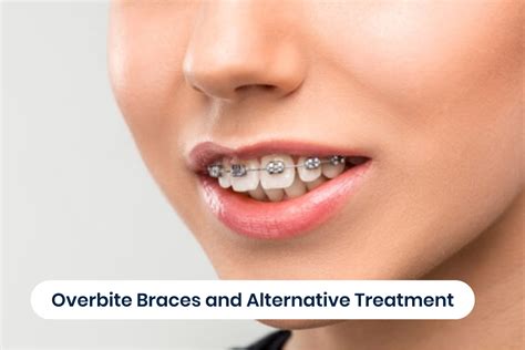 A Complete Guide To Overbite Braces