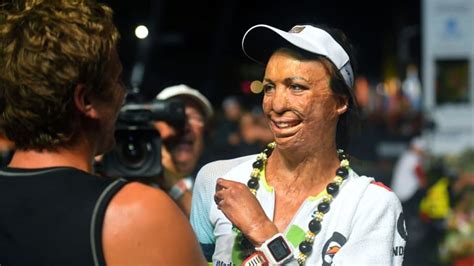 Turia Pitt Who Was Burned In Wa Ultramarathon Finishes Hawaiian Ironman
