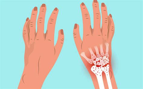 Tràn dịch khớp cổ tay là gì Nguyên nhân gây bệnh và cách điều trị