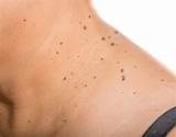 Skin Tag Removal Doctor Images