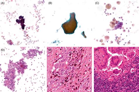 Colloid And Pigmented Histiocytes In Lymph Node Aspirates As A Clue To