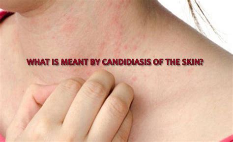 What Is Meant By Candidiasis Of The Skin Yabibo