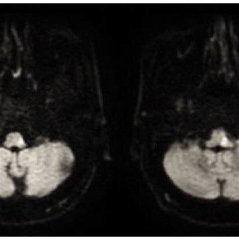 Left Lateral Medullary Infarction Along Axial Magnetic Resonance