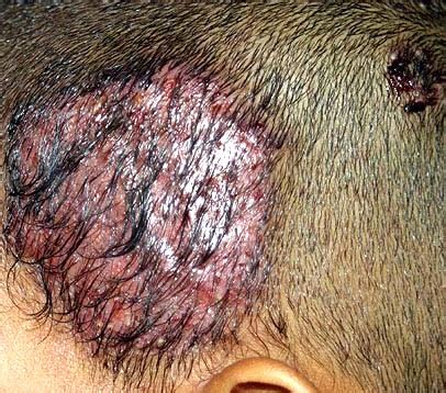 Tinea capitis — Medlibes: Online Medical Library