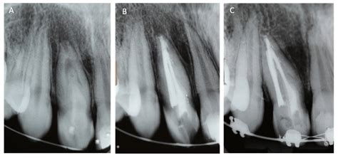 Nonsurgical endodontic management of dens... | F1000Research