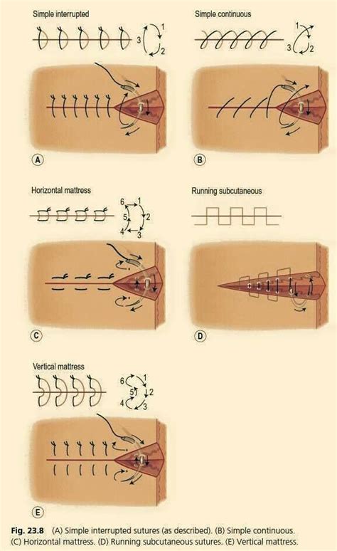 Suture Types Surgical Nursing Medical School Studying Surgical Suture