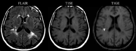 Mri Detection Of Hypointense Brain Lesions In Patients With Multiple