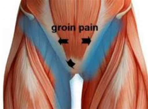 The groin or adductor muscles attach to the pubis and run down the inside of the thigh. The chronic groin - Ergoworks Physiotherapy