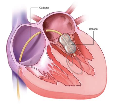 Balloon Mitral Valvuloplasty — Rodnie Oro