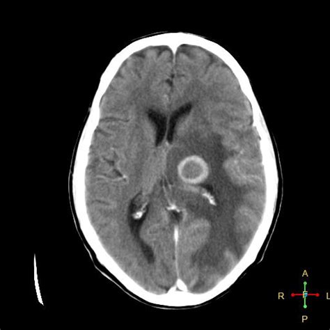 Melanoma metastases to brain | Image | Radiopaedia.org