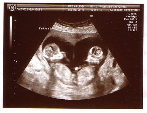 Twins 12 Week Scan Heart Shaped Cute Baby Twins Baby Ultrasound