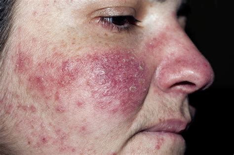 Patch Testing Beneficial In Rosacea To Detect Contact Sensitivity Dermatology Advisor
