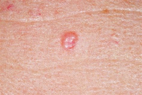 Basal Cell Carcinoma Skin Cancer Photograph By Dr P Marazziscience