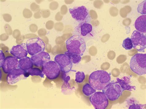 Acute Promyelocytic Leukemia Apl A Laboratory Guide To Clinical