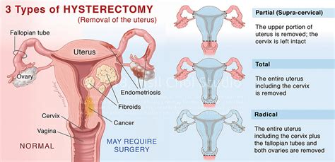 Hysterectomy Anatomy
