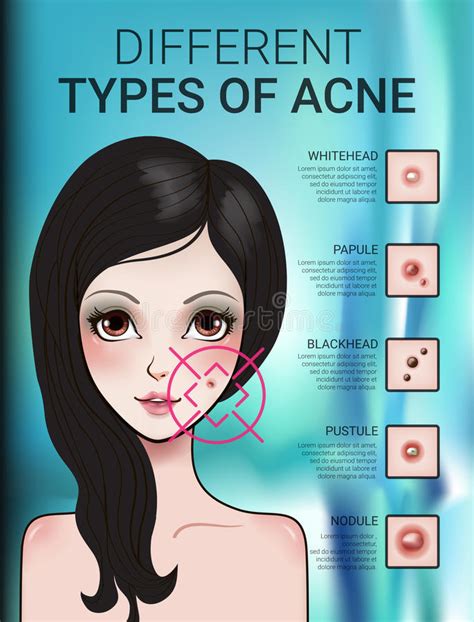 Infographics Of Different Type Of Skin Acne Stock Vector Illustration