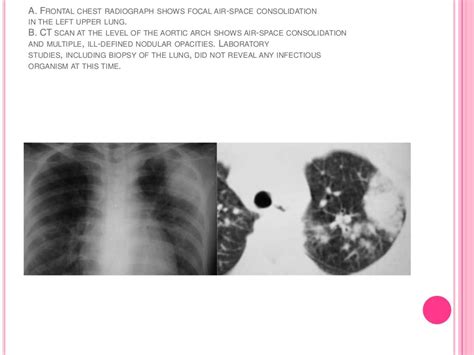 Pulmonary Manifestations Of Systemic Lupus Erythematosis