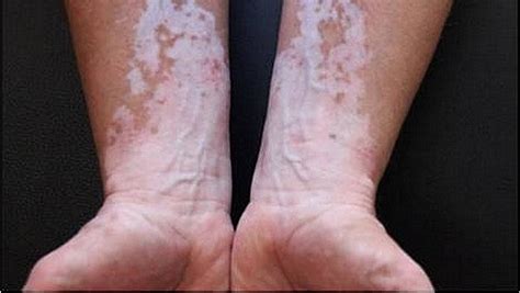 Le Vitiligo Une Maladie De La Peau Peu Connue Ladepechefr