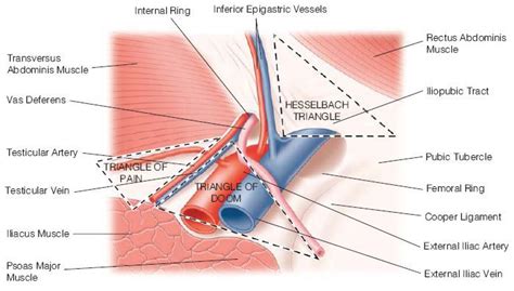 Shown Is The Left Inguinal Region With The Peritoneum Removed As Seen