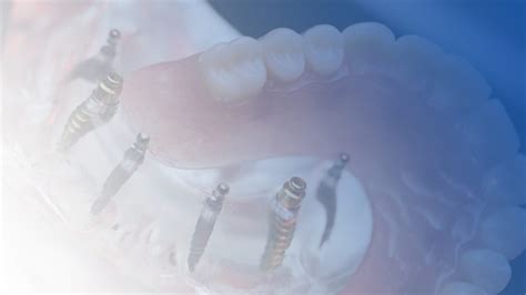 Stabili Teeth Gateway Dental And Implant Center