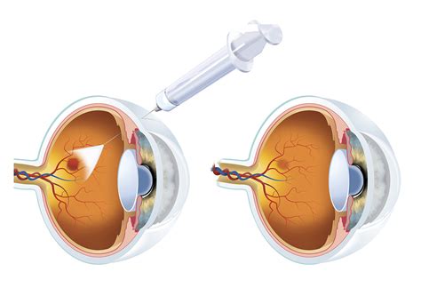 Avastin Lucentis Eylea Injections Retina Steroid Injections