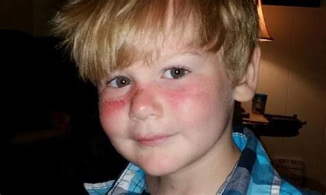 Boy Suffers Second Degree Burns After Applying Popular Sunscreen