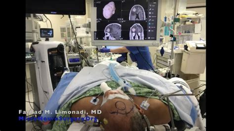Brain Tumor Resection Frontal Craniotomy And Resection Of Tumor Using