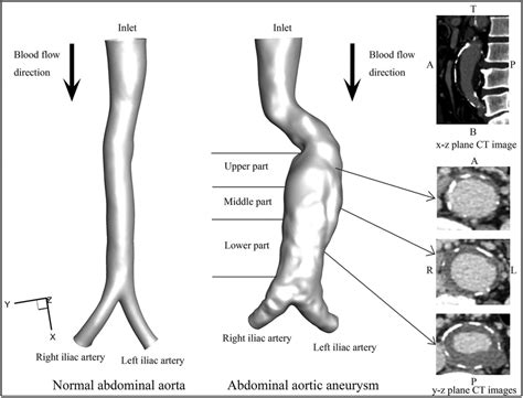 Normal Abdominal Aorta And Aaa Model With Ilt A Stands For Anterior