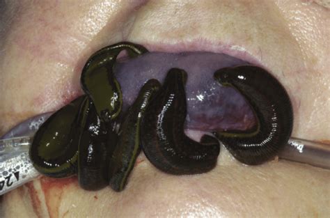 Medicinal Leeches Applied To The Tongue Download