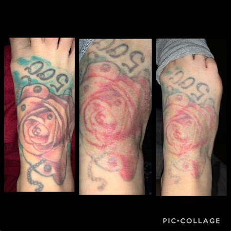 Waiting long periods between sessions really does make a change! : r/TattooRemoval