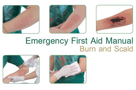 Emergency First Aid Manual Burn And Scald