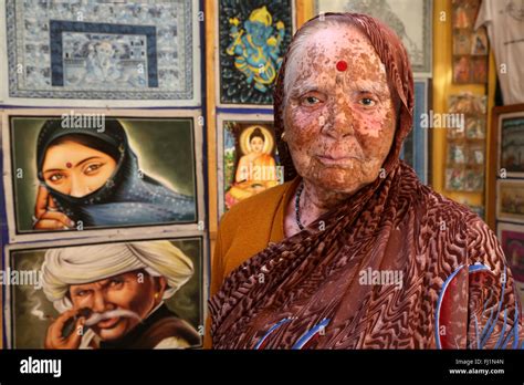 Woman With Skin Disease Called Vitiligo In Jaisalmer India Stock