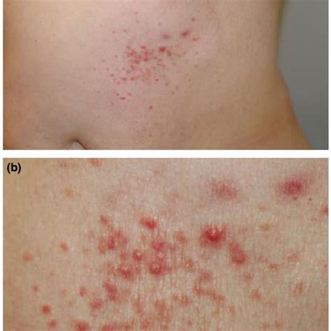 Pdf Eosinophilic Annular Erythema Complete Clinical Response With