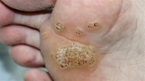 Plantar Warts Causes Symptoms Diagnosis Treatment Prevention And Healthroid