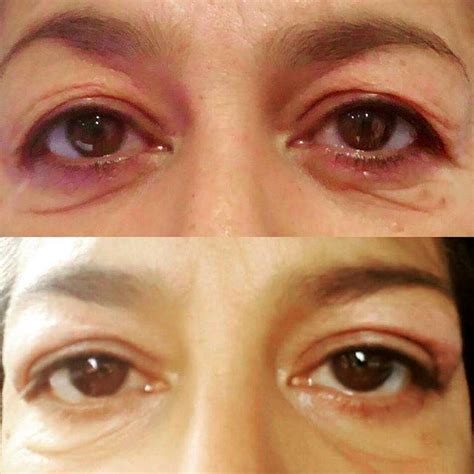 Droopy Eyelid Surgery Before And After